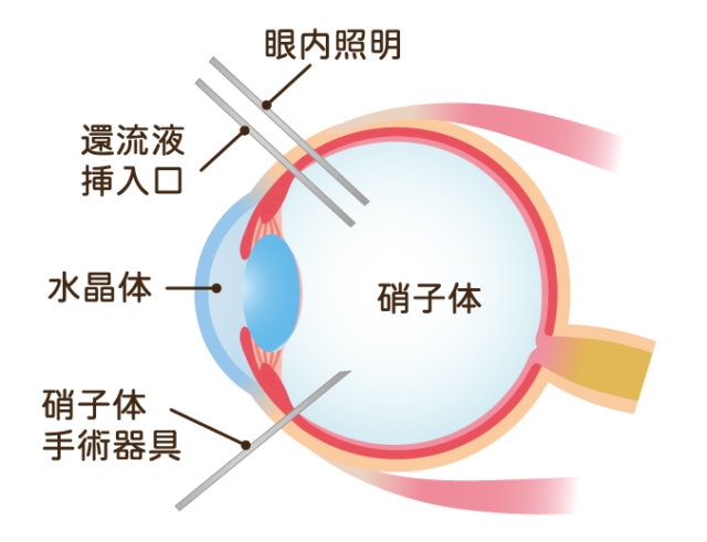 硝子体手術とは