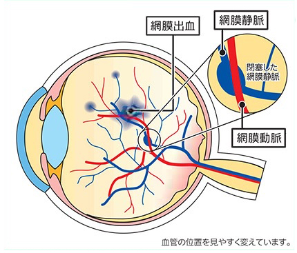 網膜静脈閉塞症⑤