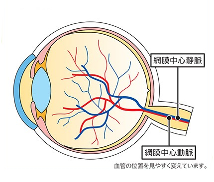 網膜静脈閉塞症④