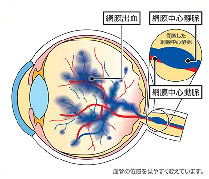 網膜静脈閉塞症③