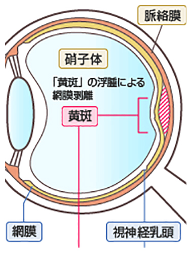 中心性漿液性脈絡網膜症