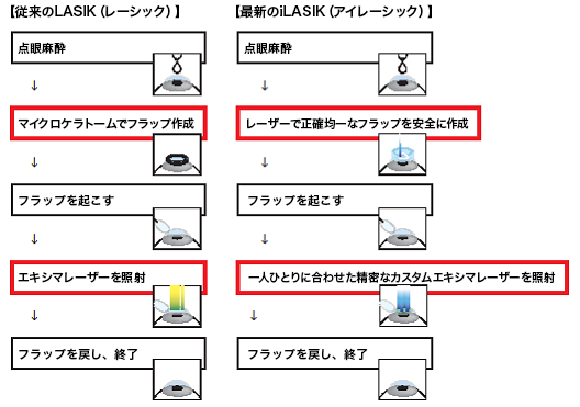 従来のLASIK（レーシック）手術とiLASIK（アイレーシック）手術の違い