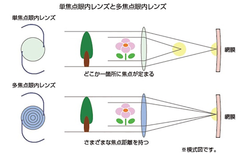 多焦点眼内レンズ