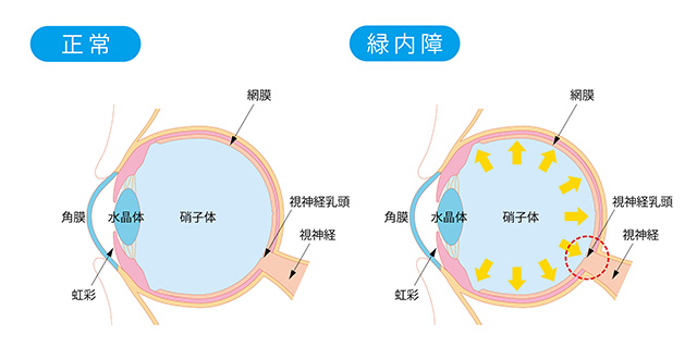 緑内障手術